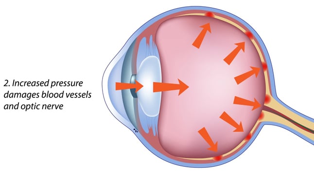 ¿Quién está en riesgo de padecer glaucoma?