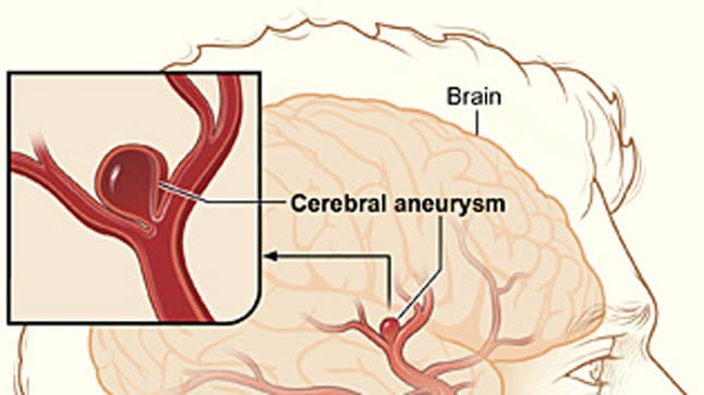 Causas, síntomas y tratamiento de la hemorragia subaracnoidea