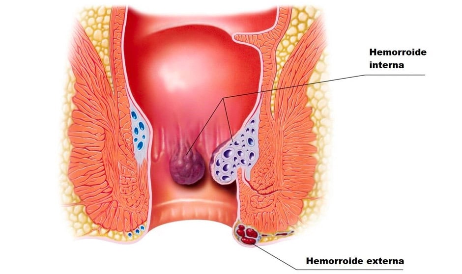 Tipos de hemorroides y ubicación de cada una de ellas.