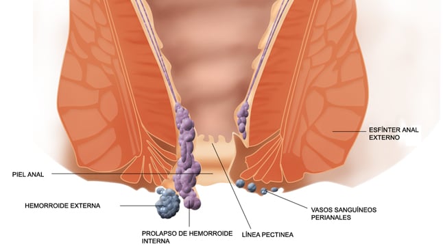 ¿Qué complicaciones tienen las hemorroides?