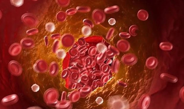Infografía de un coágulo sanguíneo