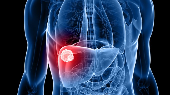 Causas, síntomas y tratamiento del hepatocarcinoma
