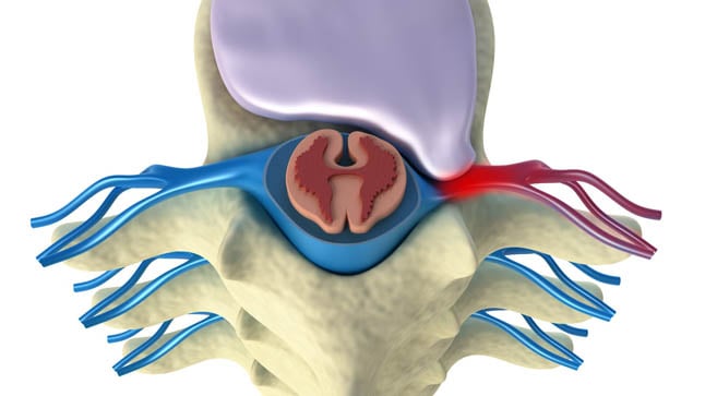 ¿Puede prevenirse la hernia discal?