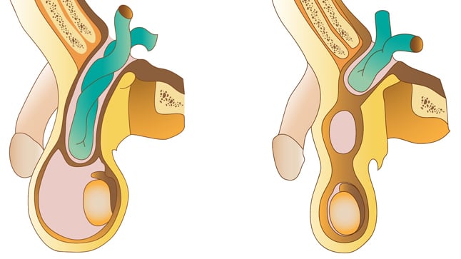 ¿Cuáles son las complicaciones de la hernia inguinal?