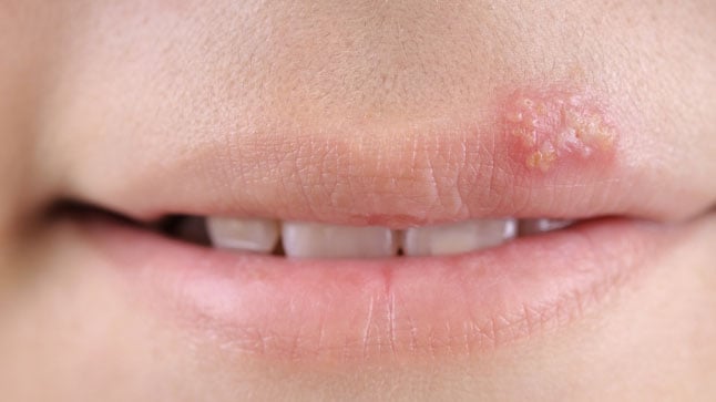 Contagio del Herpes labial y oral