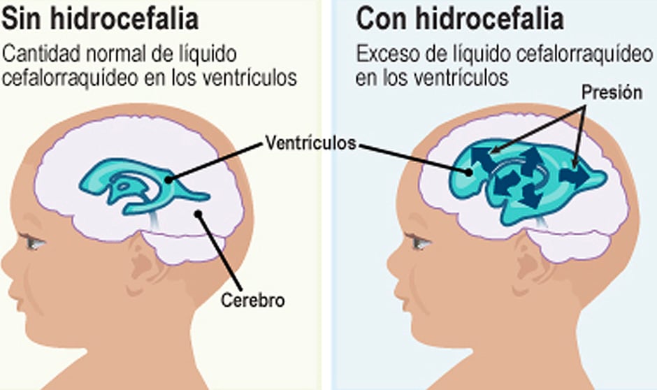 Hidrocefalia