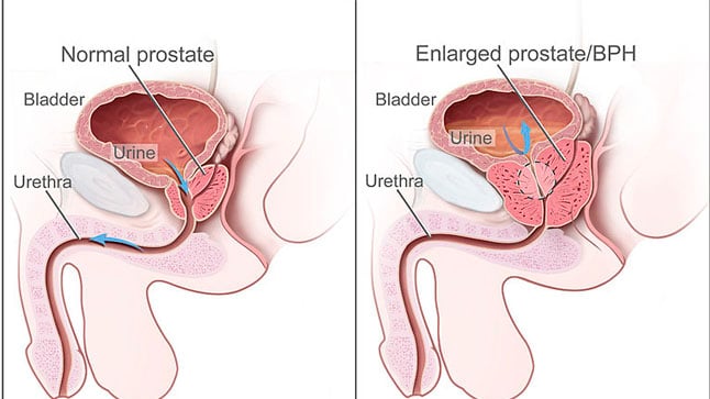 ¿Cómo se diagnostica la hiperplasia benigna de próstata?