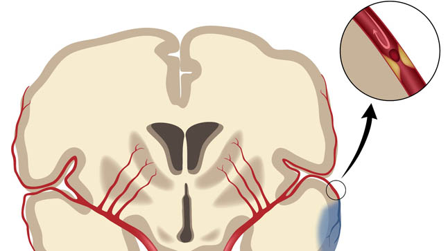 ¿Cómo se diagnostica el ictus?