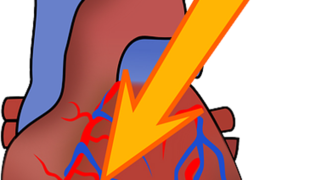 Causas, síntomas y tratamiento del infarto de miocardio