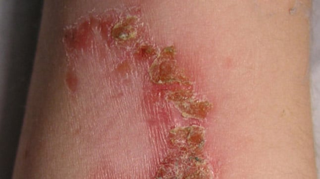 ¿Cómo se diagnostican las infecciones de la piel por bacterias?