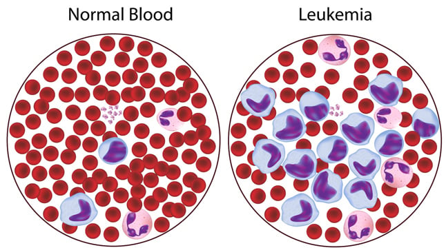 Causas, síntomas y tratamiento de las leucemias