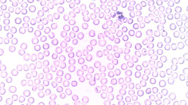 ¿Cómo se diagnostica la leucopenia?