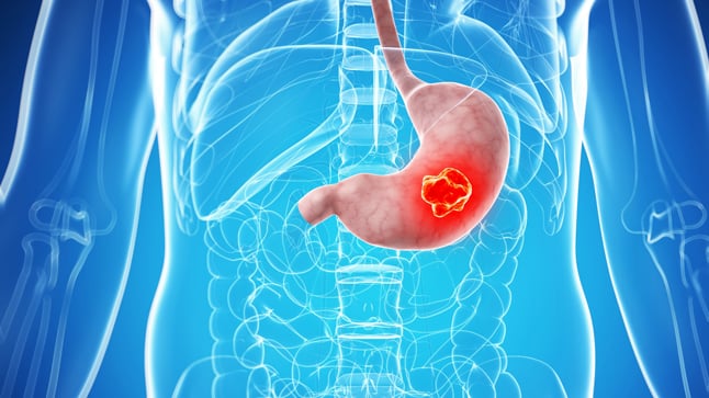 ¿Cuál es el pronóstico del linfoma gástrico?