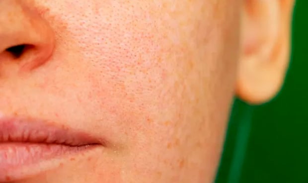 Imagen de una mujer con un melasma en la cara
