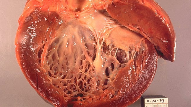 ¿Cómo se diagnostica la miocardiopatía hipertrófica?