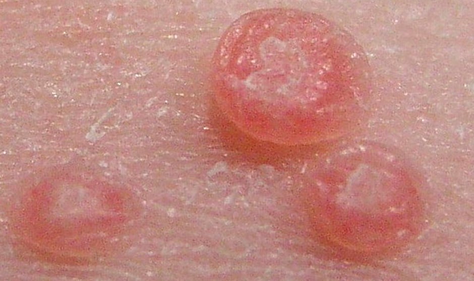 El molusco contagioso es una infección que comúnmente afecta a niños
