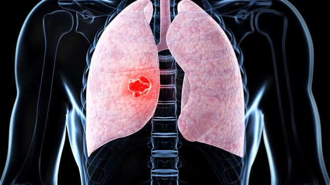 Causas y tratamiento de los nódulos pulmonares solitarios