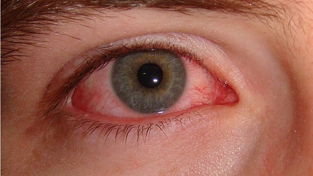 Protocolo de actuación ante un ojo rojo