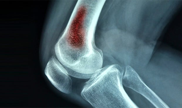 Radiografía de un hueso de rodilla con una infección