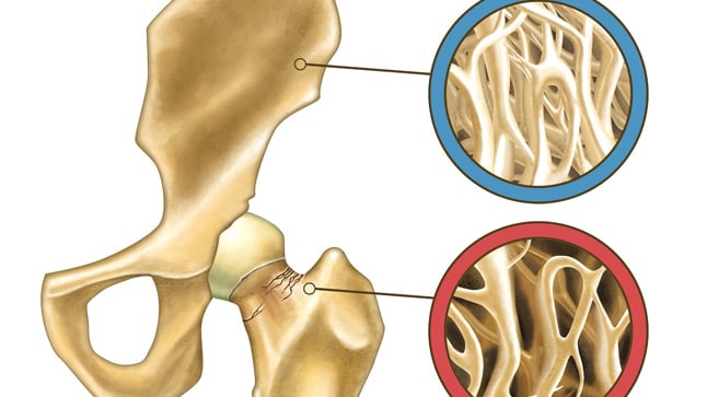 Causas, síntomas y tratamiento de la osteoporosis