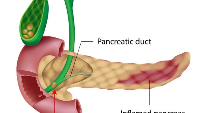 ¿Cuáles son las complicaciones de la pancreatitis aguda?