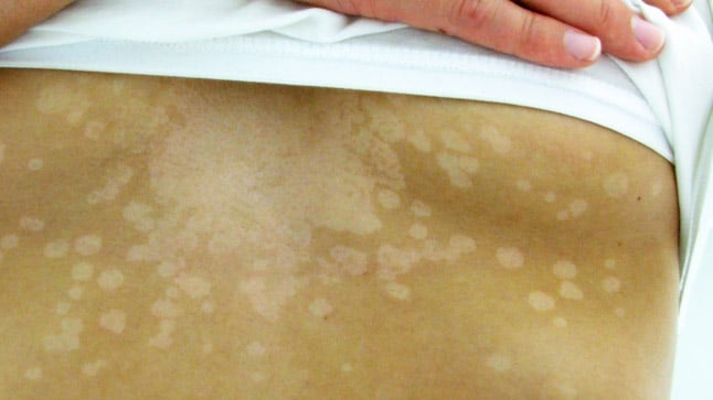 ¿Cómo se diagnostica la pitiriasis versicolor?
