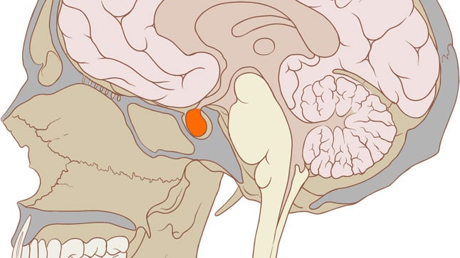 ¿Cómo se diagnostica un prolactinoma?