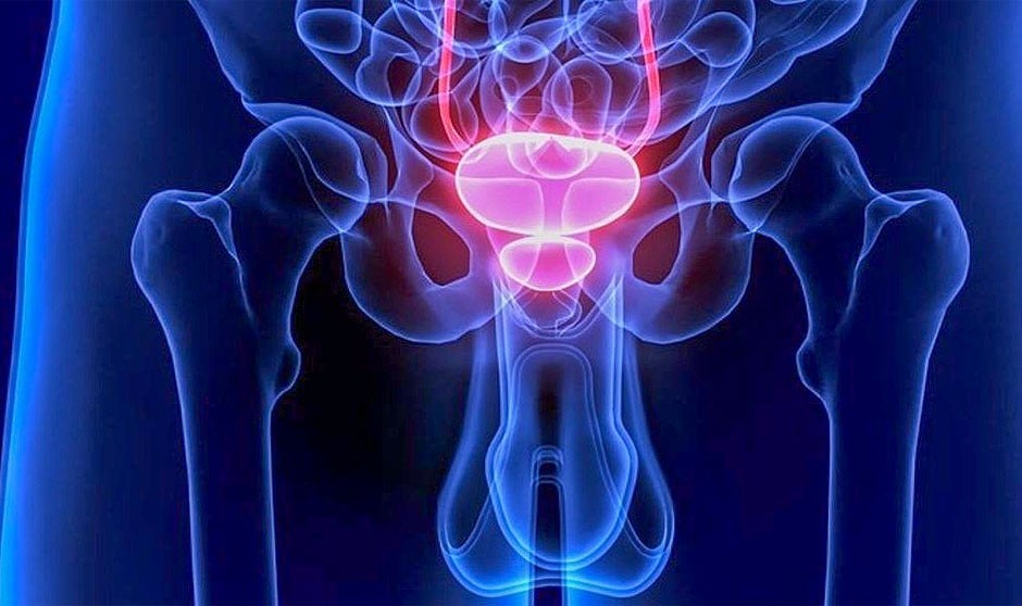 La prostatitis es una inflamación situada en la glándula prostática