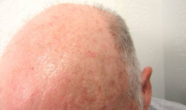 Hombre con queratosis actínico en la cabeza