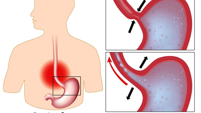 ¿Cómo se diagnostica el reflujo gastro-esofágico?