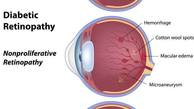 Tipos de retinopatía diabética