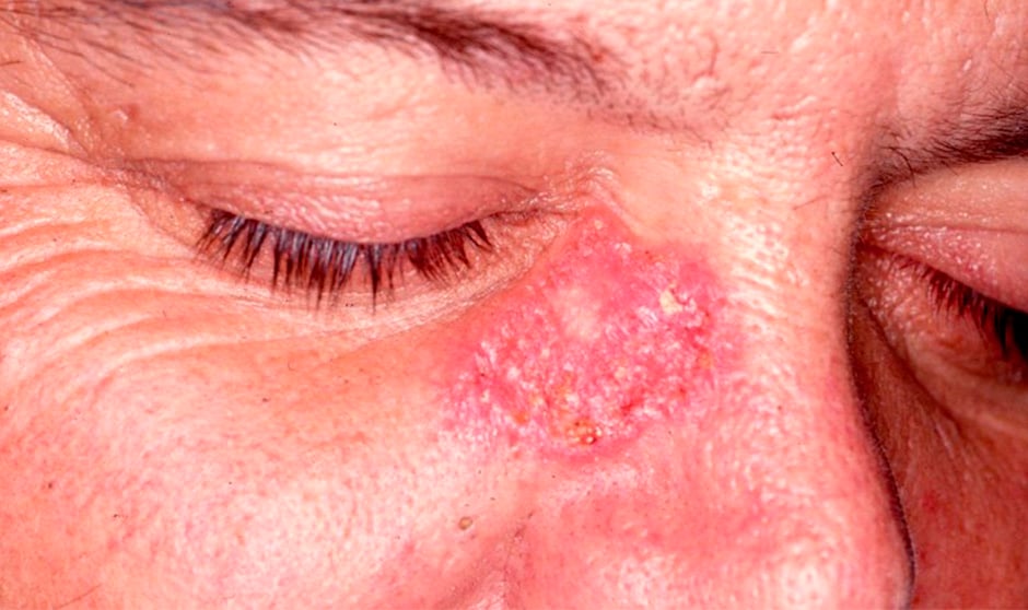 Síntomas de la sarcoidosis
