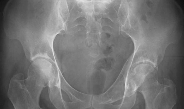 Radiografía de una cadera humana