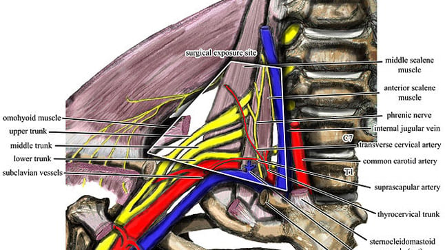 ¿Cómo se diagnostica el síndrome de compresión de la salida torácica?