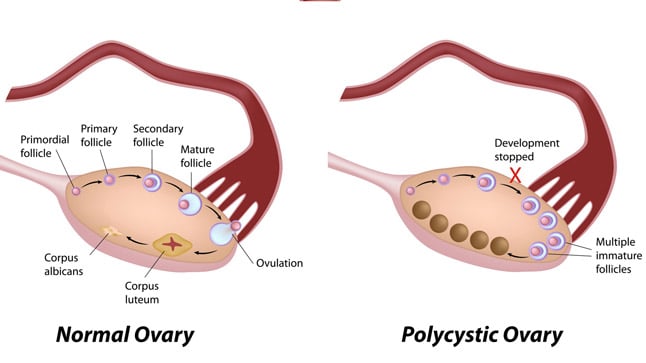 ¿Cómo se diagnostica el síndrome del ovario poliquístico?