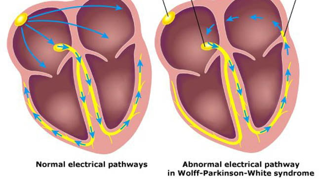 ¿Cómo se diagnostica el síndrome de Wolff-Parkinson-White?