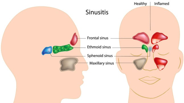 Causas, síntomas y tratamiento de la sinusitis