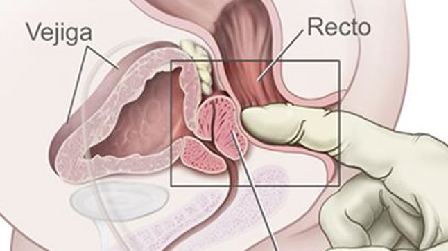 ¿En qué consiste el tacto rectal?