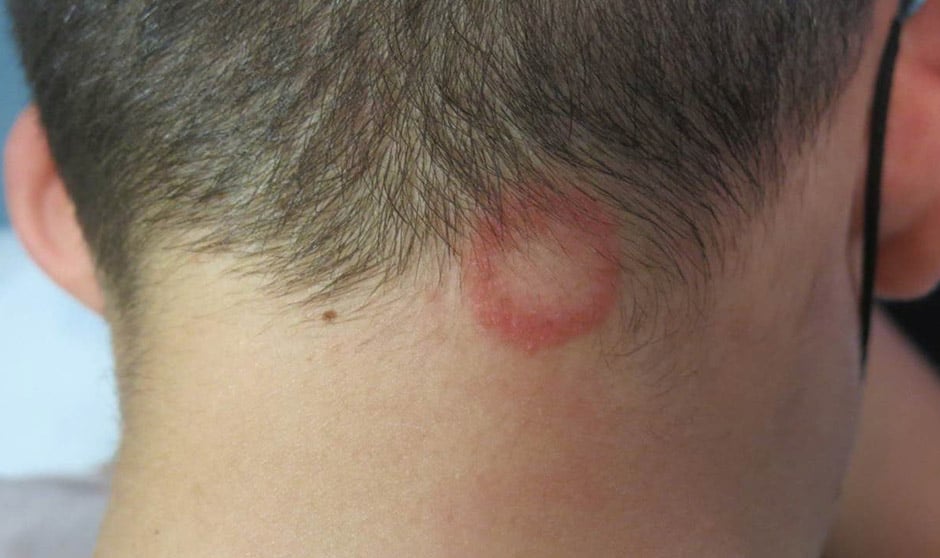 La tiña puede afectar al cuero cabelludo, la piel o las uñas.
