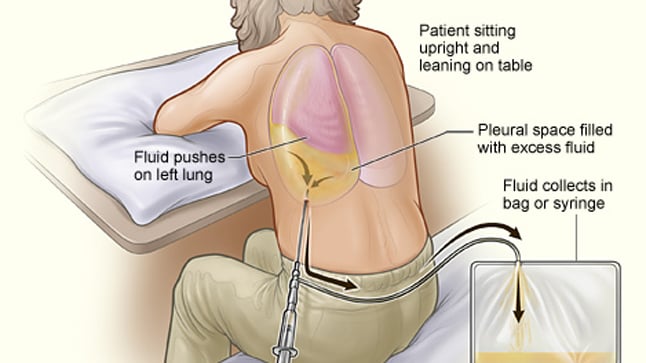 Procedimientos de la toracocentesis