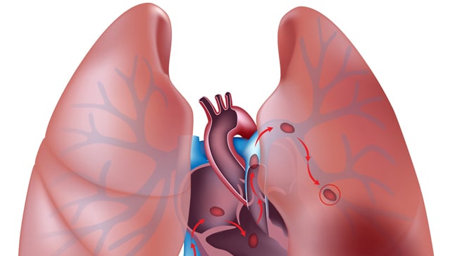 ¿Qué síntomas produce el tromboembolismo pulmonar?