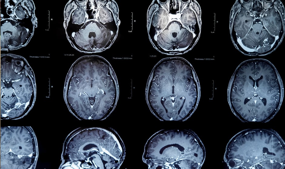 El tumor cerebral no tiene causas concretas y sus síntomas varían en función de la tipología.