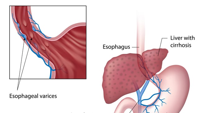 ¿Cómo se diagnostican las varices esofágicas?