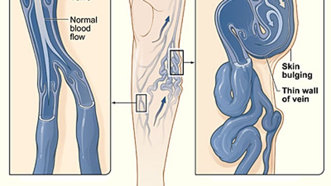 ¿Cuáles son las complicaciones de las varices?