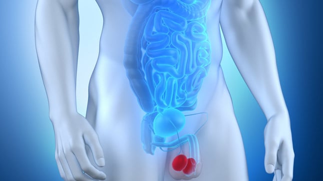 ¿Puede prevenirse el varicocele?