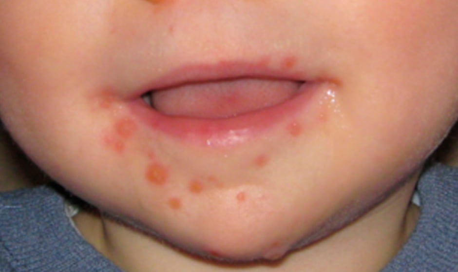 Virus boca-mano-pie: qué es, causas, síntomas y tratamiento